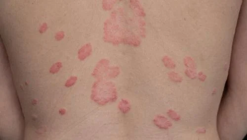 Waspada Ringworm di Pusat Kebugaran: Ancaman Jamur Menyelinap di Balik Alat Fitness!