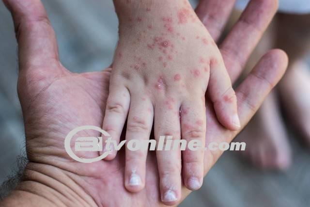 Dinas Kesehatan Sulut Bantah Masuknya Penyakit Cacar Monyet (Mpox) di Wilayahnya