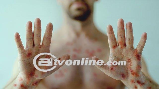 Tiga Warga Bogor Diduga Terpapar Cacar Monyet (MPOX) ?!