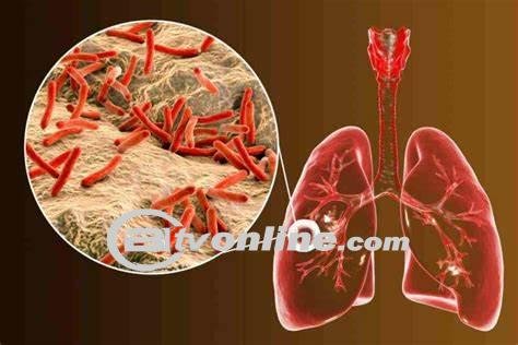 Tingginya Angka Kasus Tuberkulosis di Kota Medan: Dinas Kesehatan Siapkan Gerakan Cepat Tangkap
