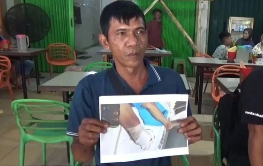 Polda Sumut Tindaklanjuti Dugaan Malapraktik Pasien Kaki Diamputasi Tanpa Persetujuan