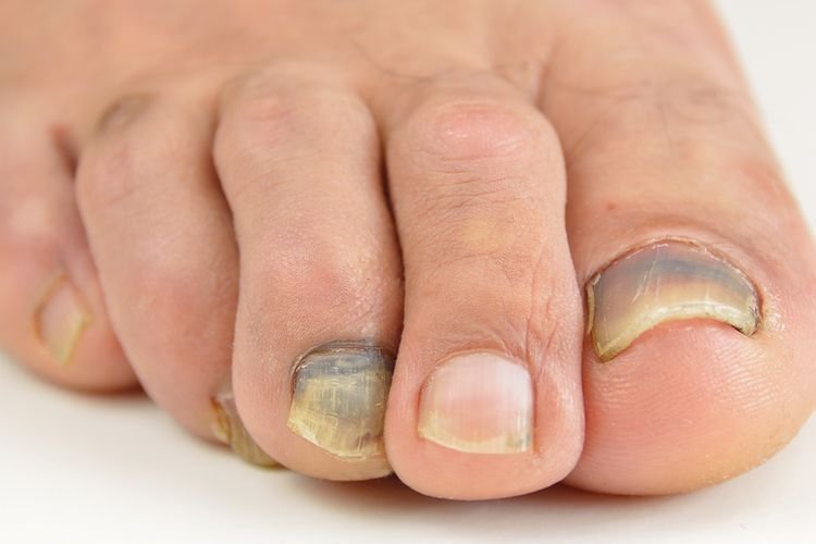 Waspadai 8 Masalah pada Kuku Kaki, Bisa Jadi Tanda Penyakit Serius