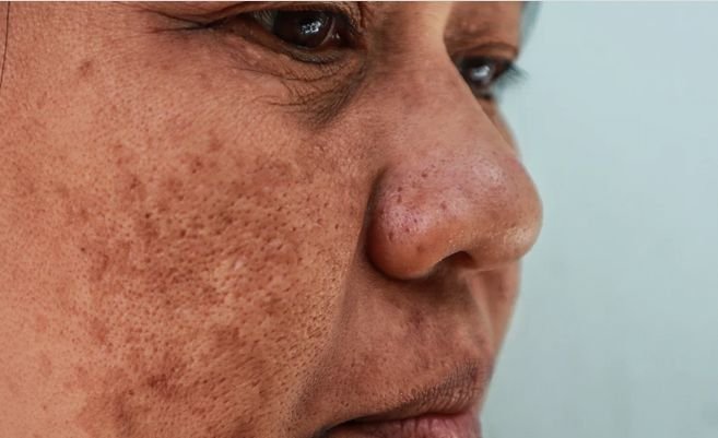 Viral Perubahan Wajah Ibu Selama Hamil, Dokter: Efek Hormon dan Bisa Dikelola